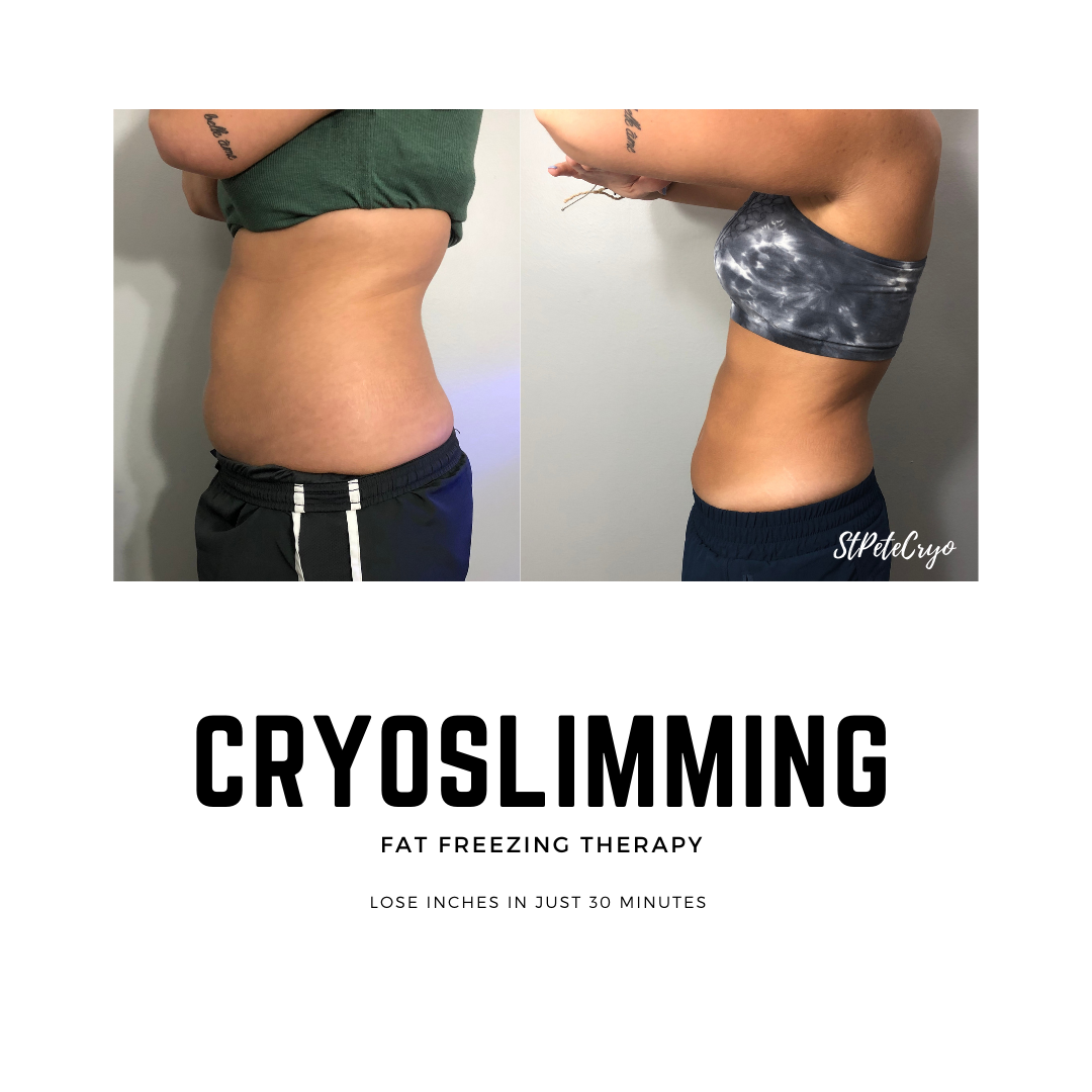 Body Sculpting of St Petersburg (Cryo Slimming/Toning/Facial) and Light Therapy