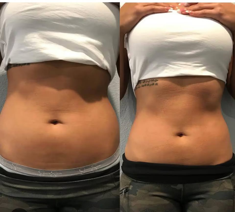 CRYO360 – Cryothérapie, Laser, IPL, Agents de comblement, Neuromodulateurs, Soins esthétiques